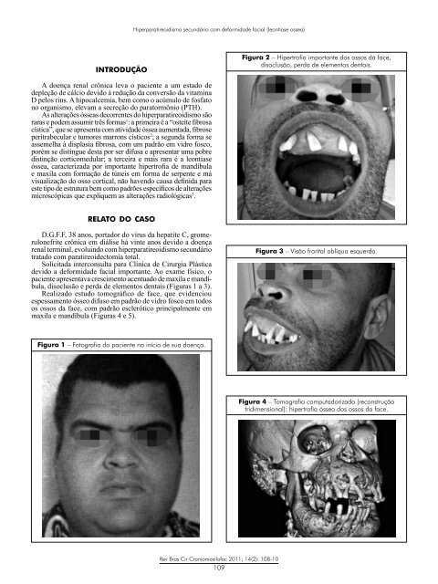 Hiperparatireoidismo secundÃ¡rio com deformidade facial ... - ABCCMF