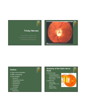 Tricky Optic Nerves and OCT Analysis