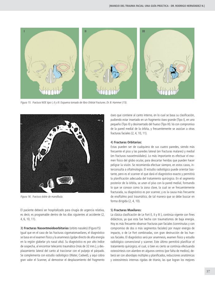 noe fractura