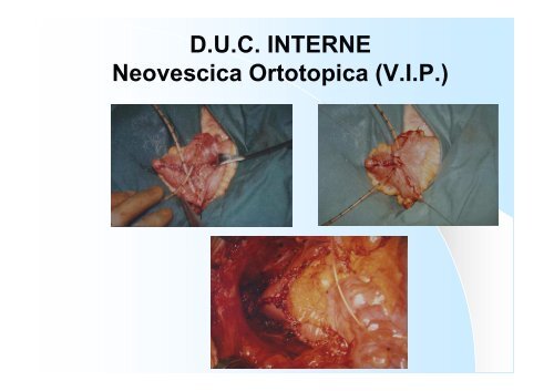 UROSTOMIE TEMPORANEE Nefrostomia - Dr. Giovanni Casetta