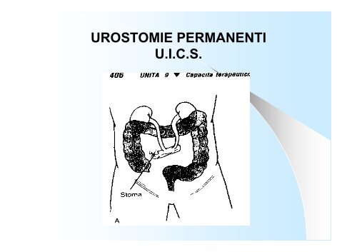 UROSTOMIE TEMPORANEE Nefrostomia - Dr. Giovanni Casetta