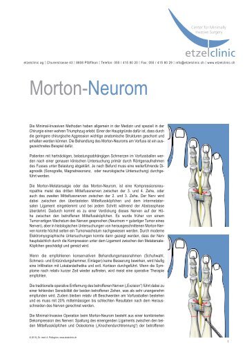 Morton-Neurom - in der etzelclinic