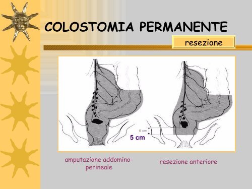 Colostomia Permanente Ind