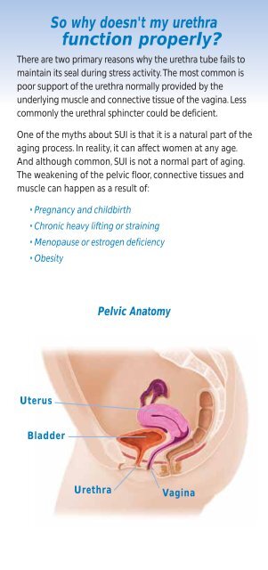 Stress Urinary Incontinence in Women