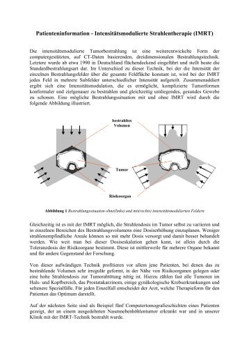 Intensitätsmodulierte Strahlentherapie \(IMRT\)