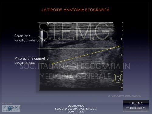 LA%TIROIDE% ANATOMIA%ECOGRAFICA%