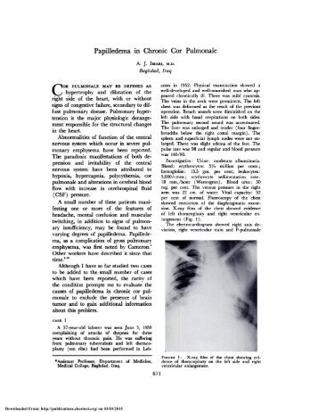 Papilledema in Chronic Cor Pulmonale