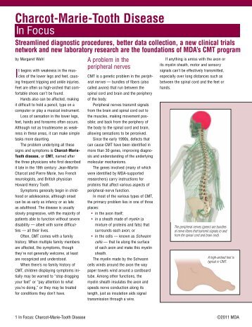 In Focus: Charcot-Marie-Tooth Disease (PDF)