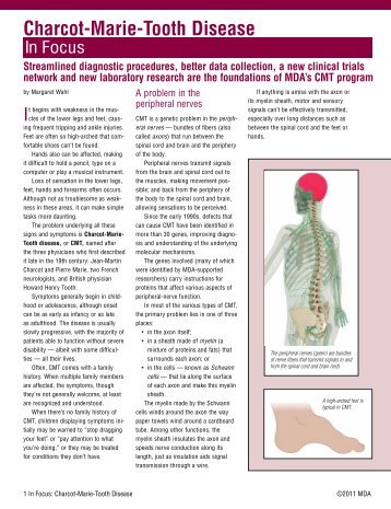 In Focus: Charcot-Marie-Tooth Disease (PDF)