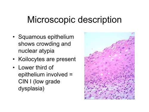 Cone biopsy of cervix - Rcpa.tv