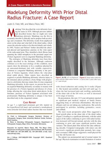 Madelung Deformity With Prior Distal Radius Fracture: A Case ...