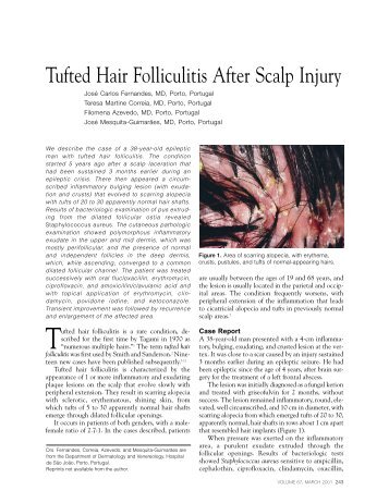 Tufted Hair Folliculitis After Scalp Injury