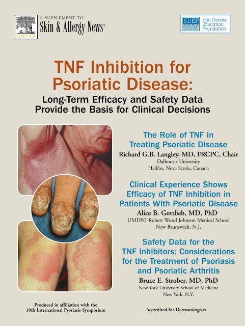 TNF Inhibition for Psoriatic Disease: - Global Academy for Medical ...
