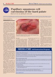Papillary squamous cell carcinoma of the hard palate - CAPP