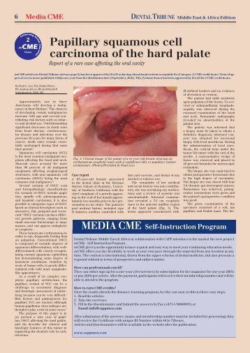 Papillary squamous cell carcinoma of the hard palate - CAPP