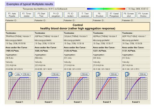 Examples of typical Multiplate results Control healthy blood donor ...