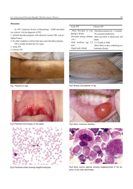 Corticosteroid Resistant Idiopathic Thrombocytopenic Purpura ...