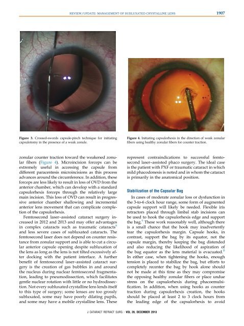 Management of Subluxated Lens