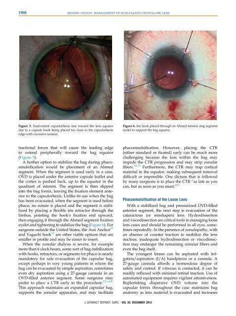 Management of Subluxated Lens