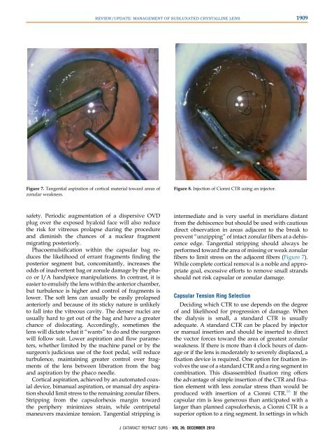 Management of Subluxated Lens