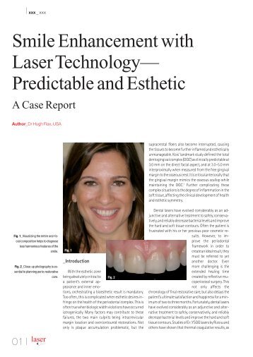 Smile Enhancement with Laser Technology ... - Flax Dental