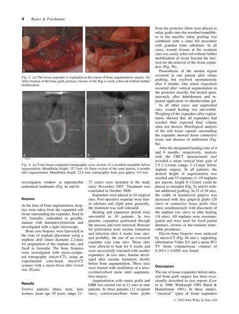 Soft tissue expansion with self-filling osmotic tissue expanders ...