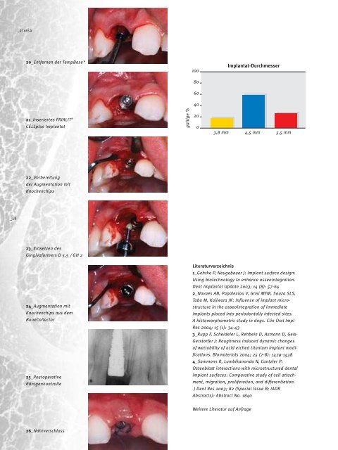 BEAUTY and SPEED - DENTSPLY Friadent