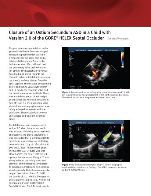 Printable PDF Version - Gore Medical