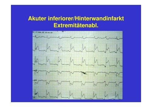 Ablauf akuter Myokardinfarkt