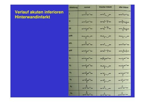 Ablauf akuter Myokardinfarkt