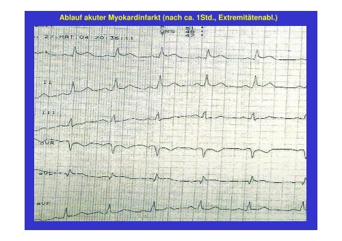 Ablauf akuter Myokardinfarkt