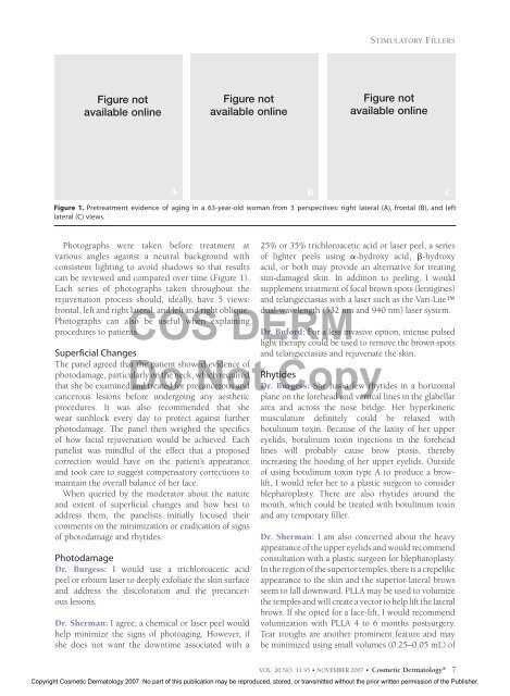 The Role of Stimulatory Fillers in Aesthetic Facial Rejuvenation