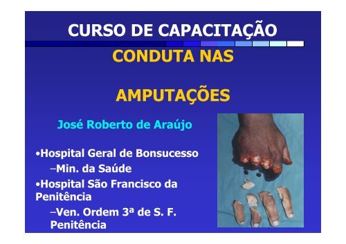 CONDUTA NAS AMPUTAÃÃES CURSO DE CAPACITAÃÃO