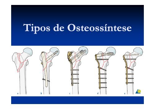 Fraturas de Membro Inferior.pdf