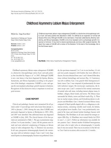 Childhood Asymmetry Labium Majus Enlargement - The Korean ...