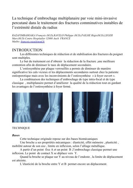 La technique d'embrochage multiplanaire par voie ... - desc orthopedie