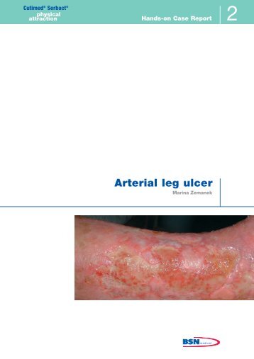 Arterial leg ulcer - Cutimed