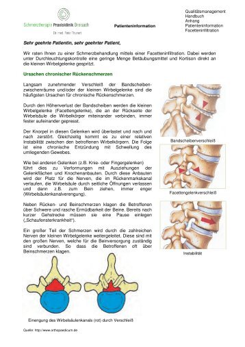 Facetteninfiltration - Schmerztherapie Praxisklinik Breisach