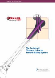 The Centronail Titanium Universal Femoral Nailing System - Orthofix