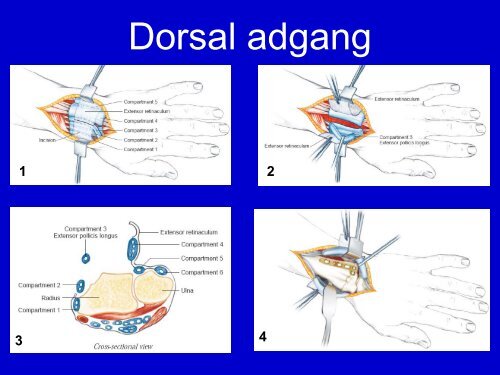 Distale radius frakturer