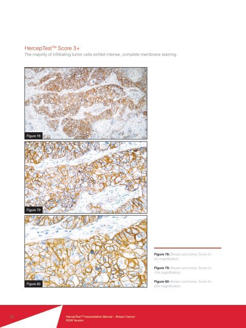 HercepTestâ¢ Interpretation Manual - Breast - Dako