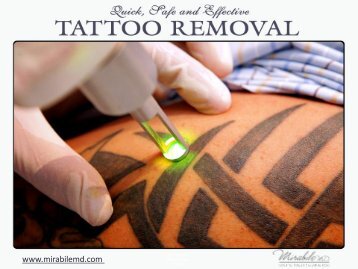 Quick and Permanent Tattoo Removal in Kansas City