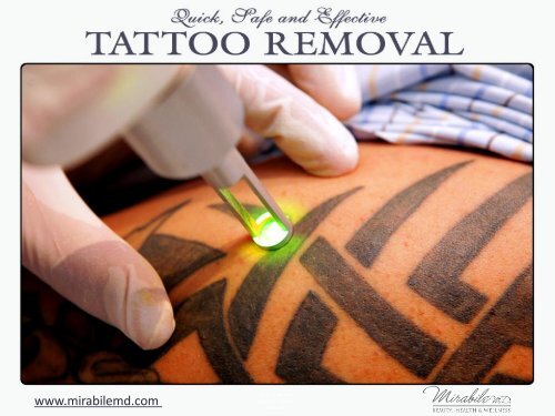 Quick and Permanent Tattoo Removal in Kansas City