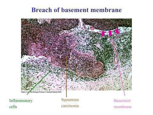 Invasion and metastasis - Experimental Oncology Graduate Study