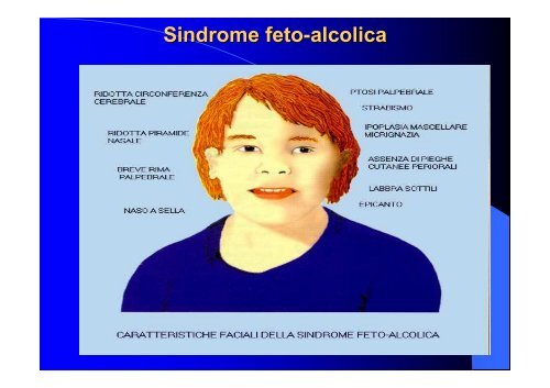 Sindrome feto-alcolica - Cedostar