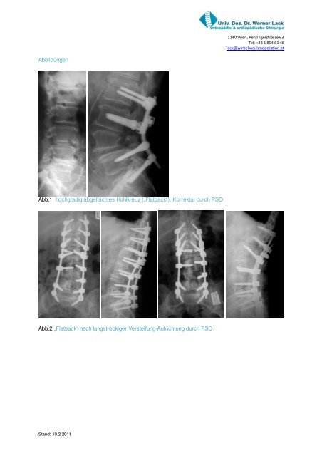 Die Pedikelsubtraktionsosteotomie zur Behandlung des lumbalen ...