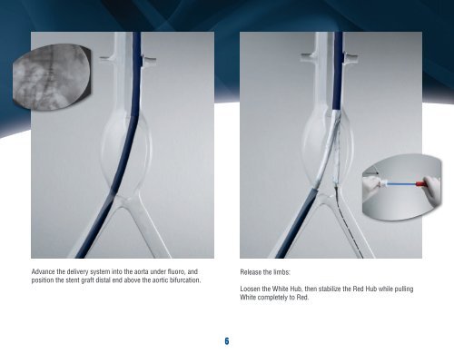 PowerlinkÂ® System for AAA Visiflex SurePass Delivery ... - Endologix