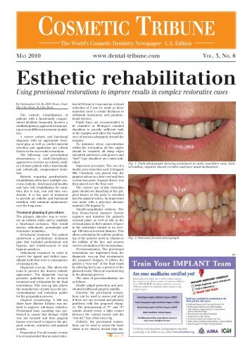 Esthetic rehabilitation - Dental Implants