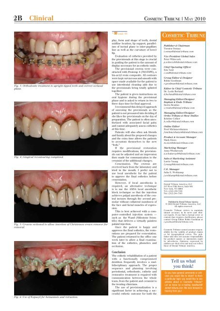 Esthetic rehabilitation - Dental Implants