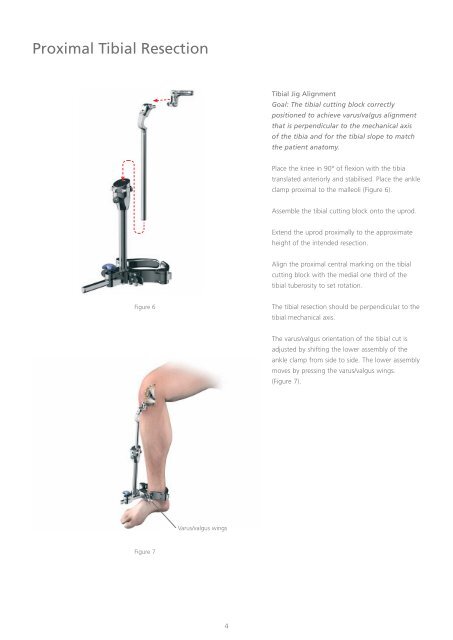 Uni- Condylar Knee Surgical Technique - Yorkshire Joint ...